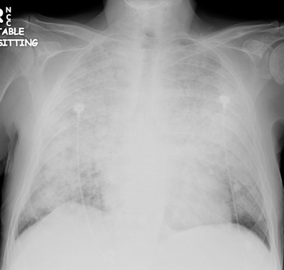 CXR (ARDS, pre-intubation)