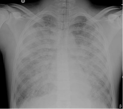 CXR (post-intubation)