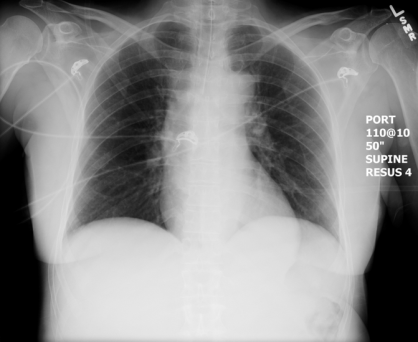 CXR (post-intubation)